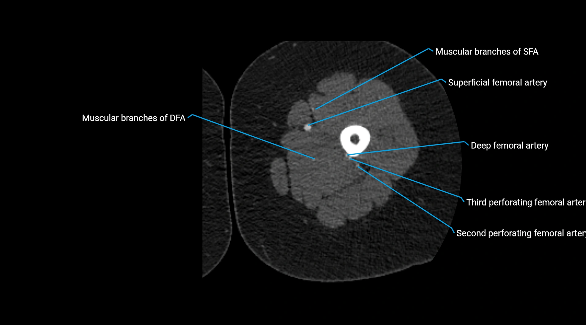 CTA lower limb cross sectional anatomy labelled image _115.webp